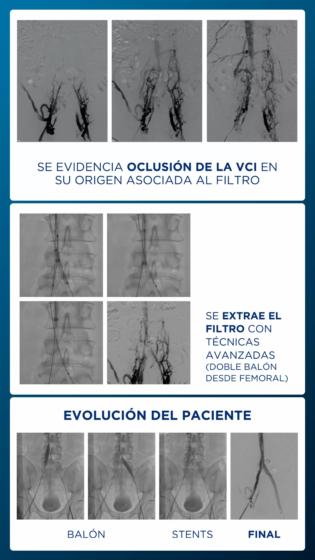 Trombosis de vena cava inferior asociada a filtro 
