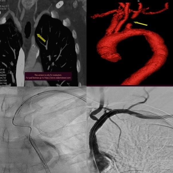 Tratamiento endovascular de oclusión de arteria subclavia izquierda